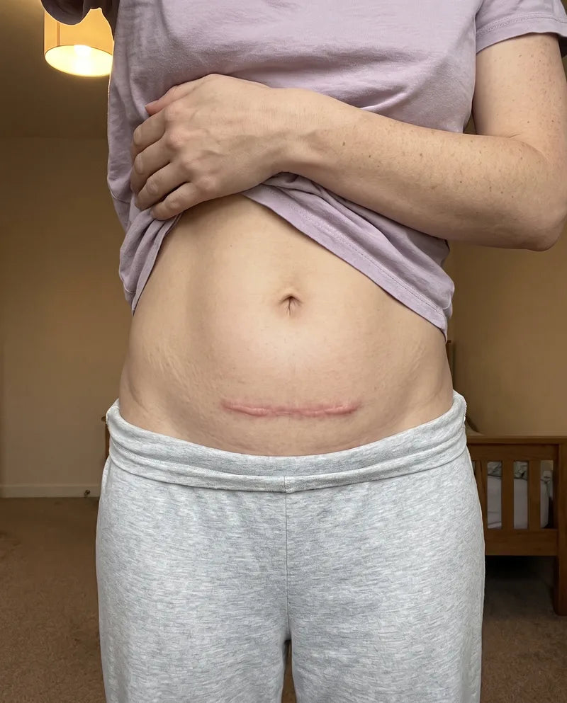 A C-section scar at week zero, pink and slightly raised.