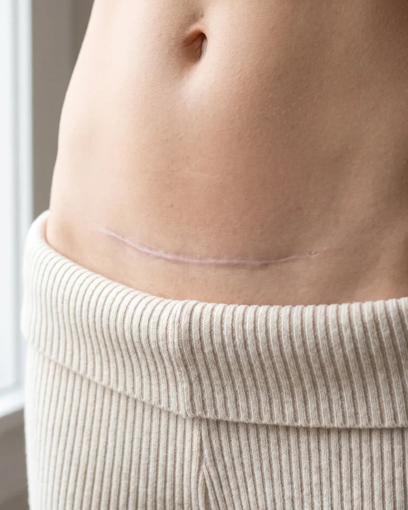 Illustration of the same scar twelve weeks later, flat and much paler.