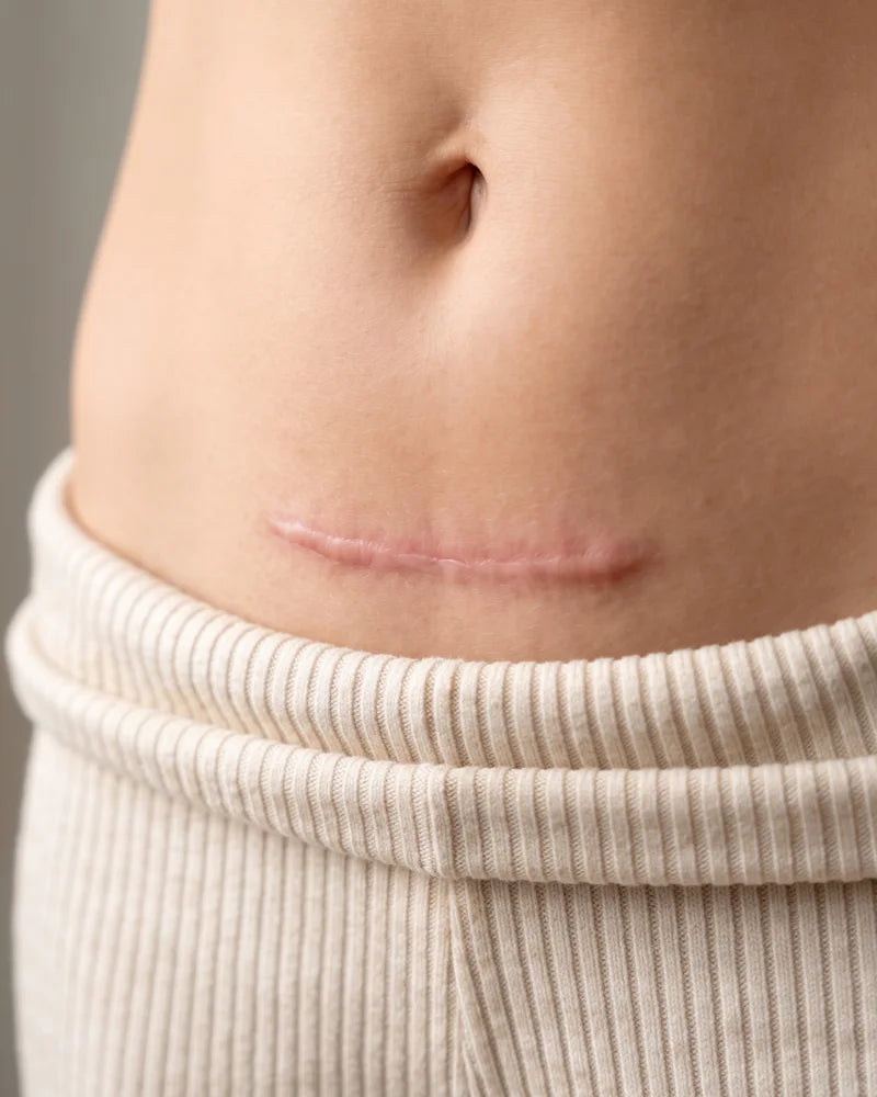 Illustration of a raised red c-section scar at week zero.