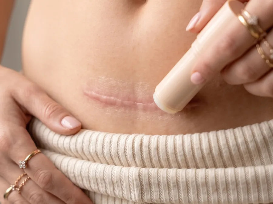 A hand gliding the Fueled stick along a c-section scar.