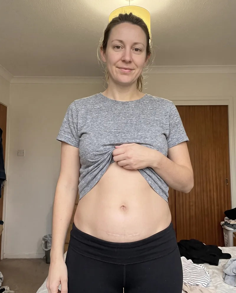 Hannah's scar twelve weeks later, flat and much fainter.