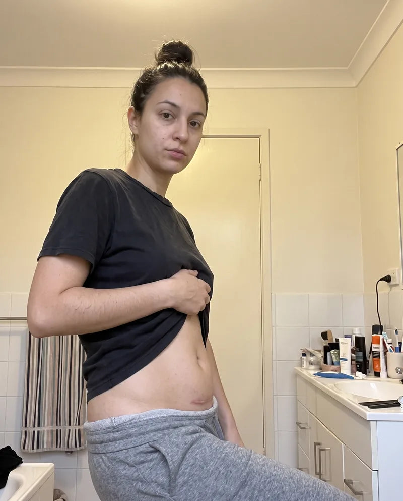 Priya sitting on the edge of the bath, her C-section scar raised and pink.