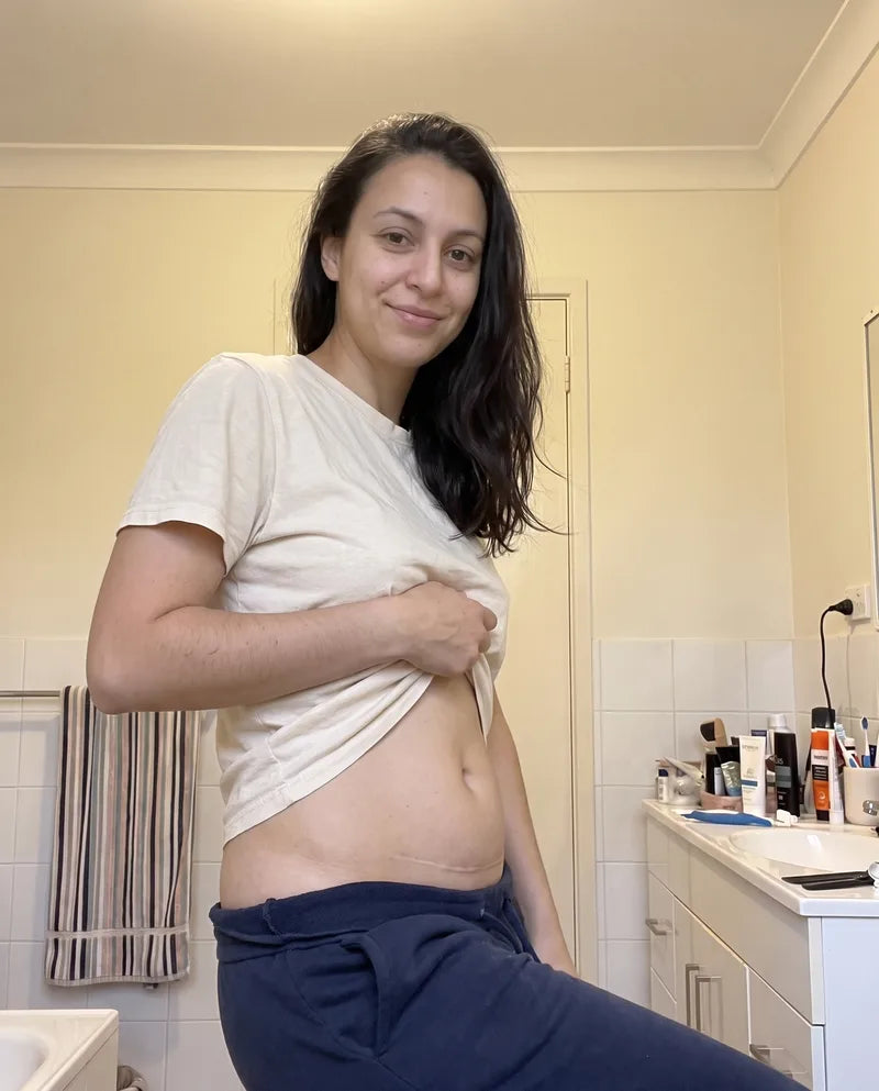 Priya's scar twelve weeks later, flat and much fainter.