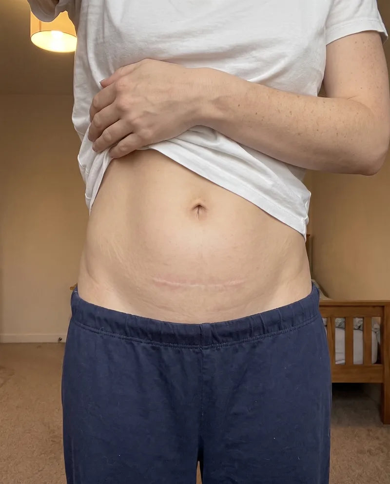 The same scar twelve weeks later, flat and much fainter.
